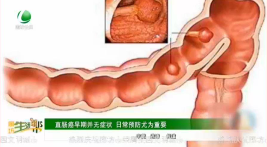 直腸癌早期并無癥狀 日常預防尤為重要